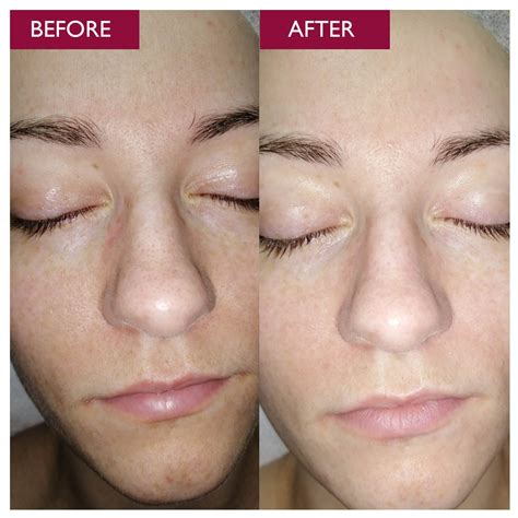 glycolic acid before and after.